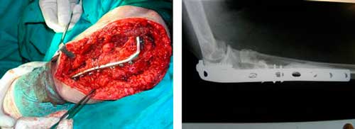 Cirugía para tratar una fractura no consolidada e infectada de codo Dr. Villanueva