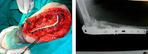 Cirugía para tratar una fractura no consolidada e infectada de codo Dr. Villanueva Cirugía para tratar una fractura no consolidada e infectada de codo Dr. Villanueva