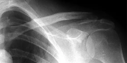 Fractura del tercio externo de la clavícula tipo III Fractura del tercio externo de la clavícula tipo III