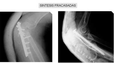 Fractura no consolidada e infectada de codo Radiografía