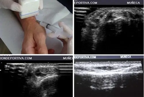 Infiltraciones para el tratamiento de la Tenosivitis de De Quervain