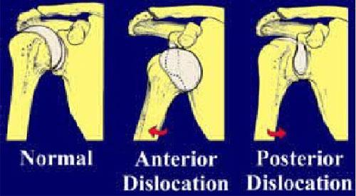 Mecanismo de lesión de la luxación de hombro