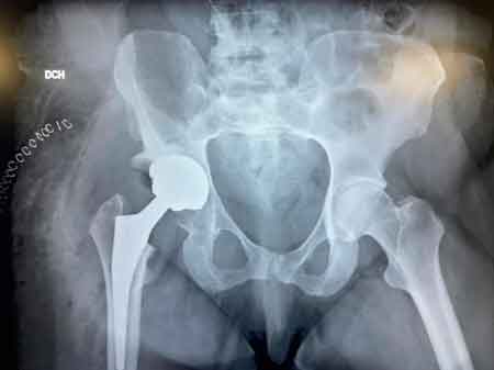 Radiografía cadera con displasia severa