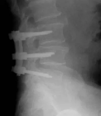 artroscopia por daños discales en la columna vertebral