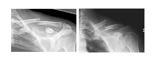 fracturas del tercio medio de la clavícula fracturas del tercio medio de la clavícula