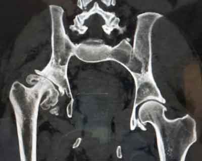 radiografía de cadera en mujer jóven con displasia desde niña 2