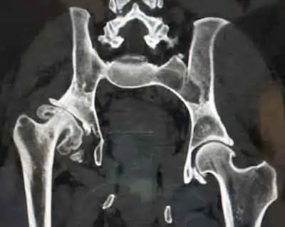 radiografía de cadera en mujer jóven con displasia desde niña 2 radiografía de cadera en mujer jóven con displasia desde niña 2