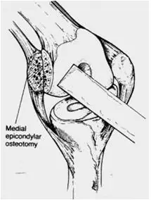 Artroplastia total de Rodilla Revision Osteotomía del epicóndilo medial