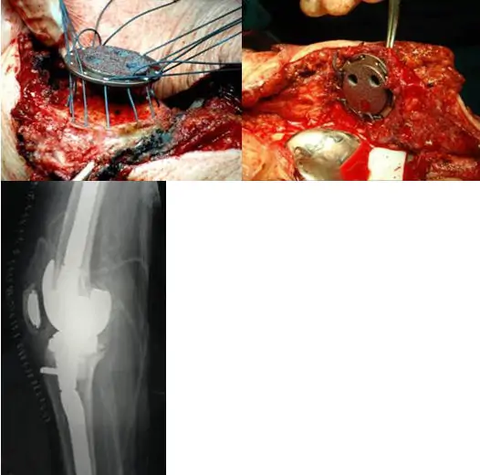 Cirugía de revisión de una prótesis de rodilla