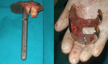 Extracción de componentes de prótesis de rodilla sin pérdida ósea