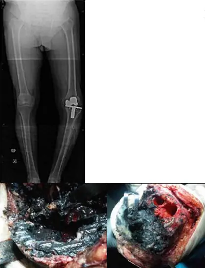 Grave osteólisis y metalosis en revisión de artroplastia total de rodilla