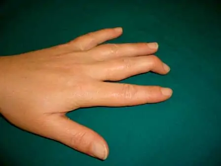 Lesiones en los dedos en el voleibol