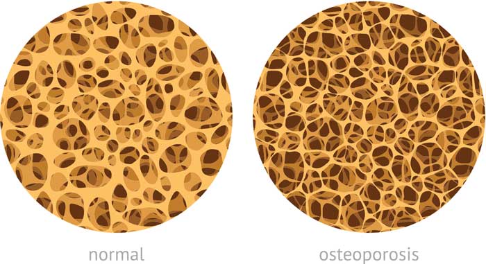 Osteoporosis por el Dr. Villanueva