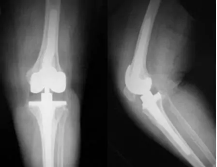 Prótesis de revisión de rodilla constreñida condilar con vástagos lateralizados