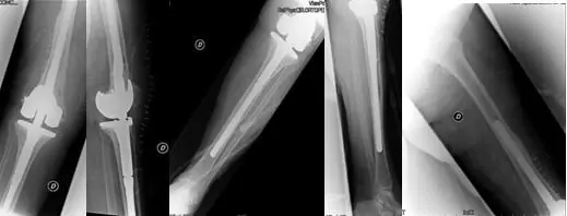 Revisión de Protésica de rodilla constreñida aflojada y dolorosa