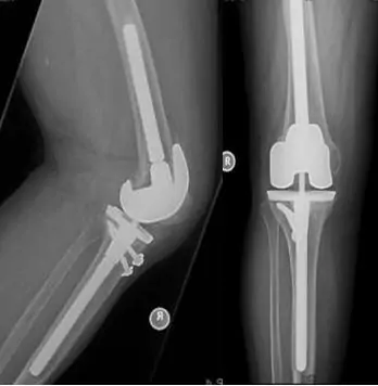 Revisión de Prótesis de rodilla constreñida de revisión aflojada y dolorosa
