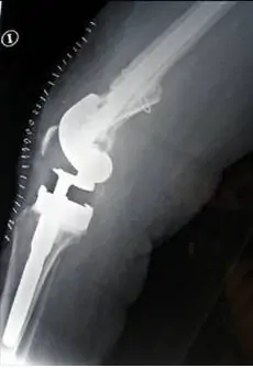 Revisión de prótesis de rodilla constreñida condilar con vástagos lateralizados