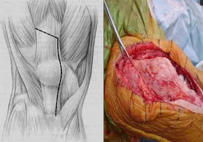 Revisión prótesis de rodilla Esquema de abordajes quirúrgicos convencionales