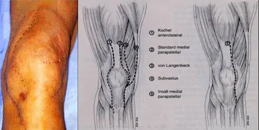 abordaje quirúrgico de revisión de prótesis de rodilla