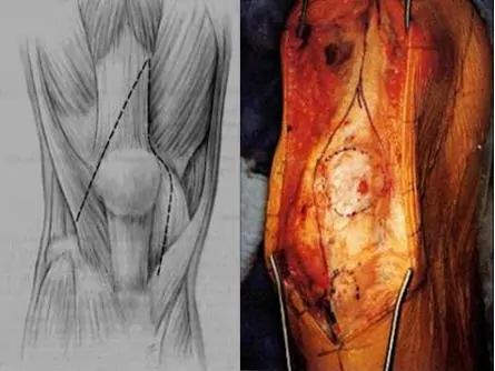 imagen quirúrgica de revisión de artroplastia de rodilla en V o Y del cuádriceps