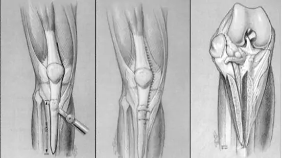 técnica de la osteotomía tibial ampliada en revisión artroplastia total de rodilla