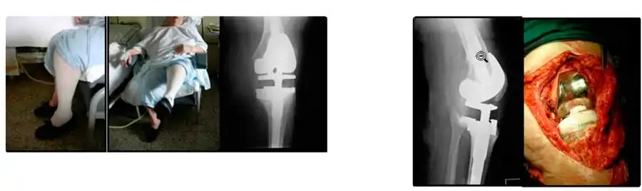 Caso clínico 1 de salvamento, fusión y amputación en las prótesis de rodilla infectadas Caso clínico 1 de salvamento, fusión y amputación en las prótesis de rodilla infectadas