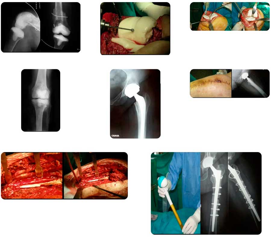 Caso clínico 2 de salvamento, fusión y amputación en las prótesis de rodilla infectadas