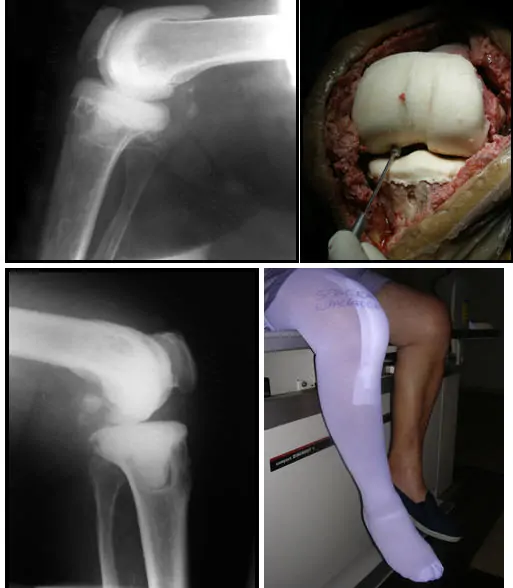 Caso clínico recambio prótesis rodilla infectada en un tiempo