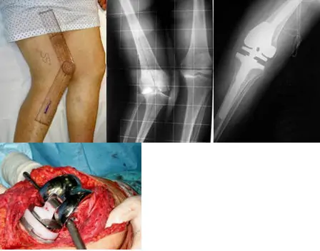 Cirugía de la inestabilidad de prótesis de rodilla