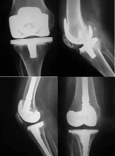 Diagnóstico de Prótesis de Rodilla Dolorosa con Pruebas de Imagen