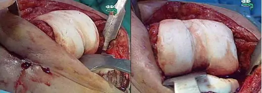 Espaciador articulado conformado manualmente en infección de prótesis total de rodilla