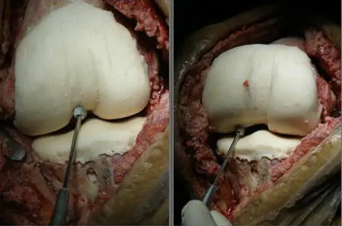 Espaciadores articulados para prótesis de rodilla infectada