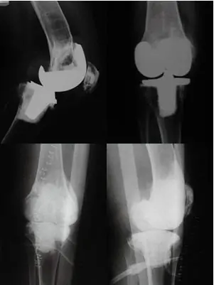 Espaciadores de prótesis de rodilla por el especialista en casos complejos de rodilla Dr. Villanueva