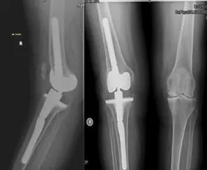 Inestabilidad (recurvatum) en prótesis de rodilla constreñida condilar de revisión