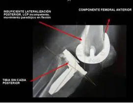 Prevención quirúrgica de la inestabilidad de prótesis de rodilla