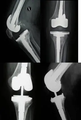 Prótesis de revisión por infección de prótesis de rodilla con polietileno ultracongruente y conflicto biomecánico