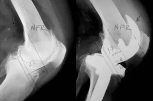Prótesis de rodilla con inestabilidad y cajón posterior en flexión.