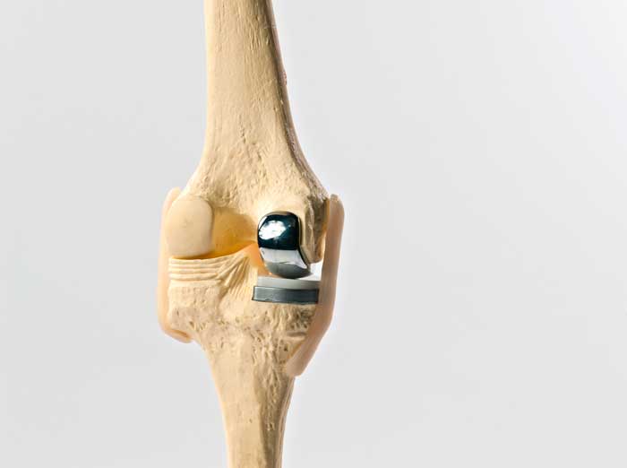 Qué Pasa si me Afloja la Prótesis de Rodilla cirugía ortopédica en Madrid
