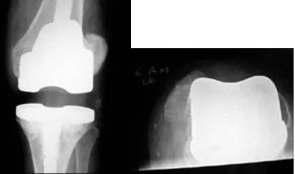 Radiografía con inestabilidad rotacional de prótesis de rodilla