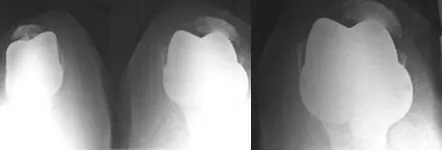 Radiografía con prótesis de rodilla con inestabilidad rotacional