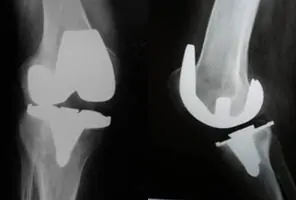 Radiografía de Prótesis de Rodilla con inestabilidad