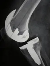 Radiografía de prótesis de rodilla inestable