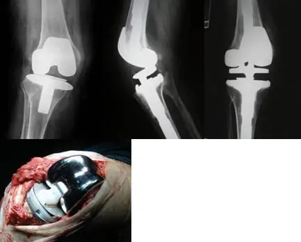 Tratamiento quirúrgico de la inestabilidad de prótesis de rodilla