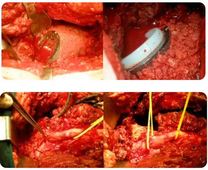 caso clínico de movilización y pérdida ósea en prótesis de rodilla