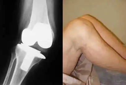 radiografía de paciente del especialista en prótesis de rodilla dolorosa