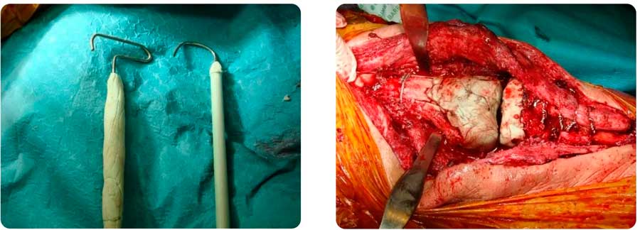imagen intraoperatoria paciente con infección crónica fistulizada de prótesis de rodilla paciente del Dr. Villanueva