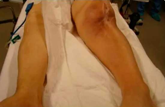 imagen previa a la cirugía-de infección crónica fistulizada de prótesis de rodilla