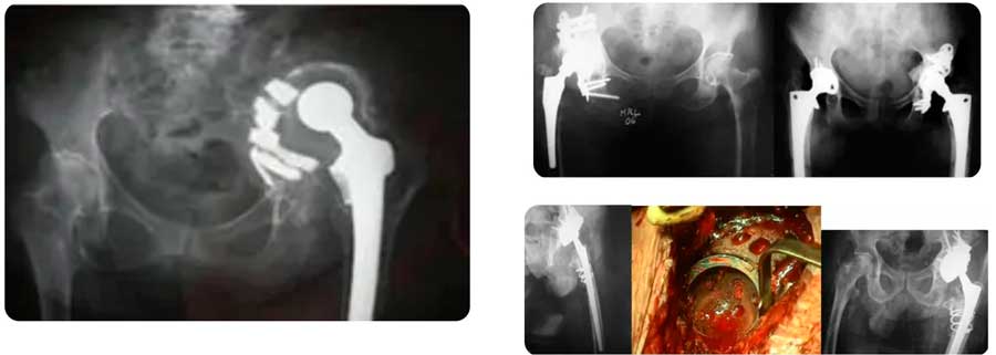 movilización y pérdida ósea en prótesis de rodilla