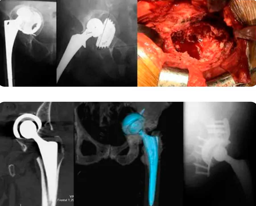 movilización y pérdida ósea masiva en prótesis de rodilla
