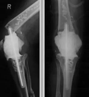 Desmontaje de espaciador de prótesis de rodilla monobloque. Radiografía de espaciador articulado para prótesis de rodilla infectada